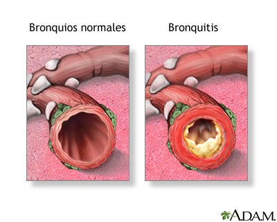 Bronquitis por causa bacteriana